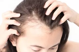 Hormonal-Hair-Loss