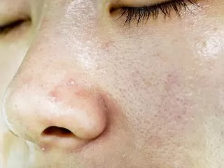 چه چیزی باعث می شود تا پوست صورت چرب شود؟